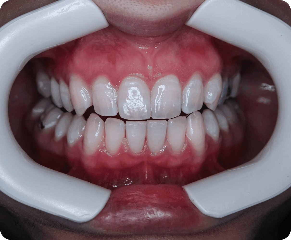 Гигиена при ортодонтическом лечении