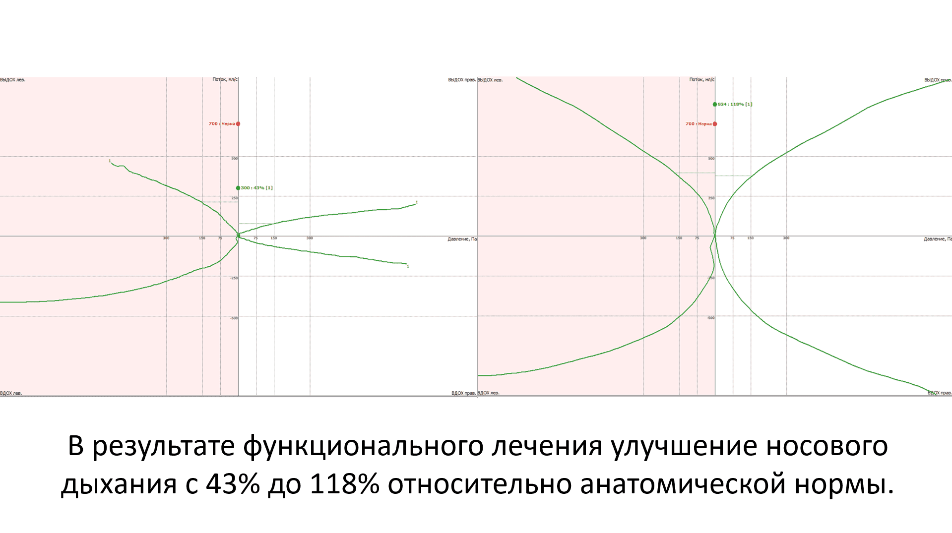 Риноманометрия
